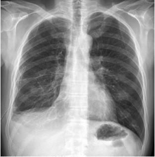 Podstawą rozpoznania gruźlicy są: badania radiologiczne laboratoryjne histopatologiczne Przy podejrzeniu gruźlicy płuc: podstawowym badaniem jest prześwietlenie płuc badanie RTG klatki piersiowej