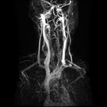 DIAGNOSTYKA I LECZENIE Badanie ultrasonograficzne (Dopplerowskie i przezczaszkowe) Podstawową metodą stosowaną w diagnostyce pacjentów z przewlekłą mózgowo-rdzeniową niewydolnością żylną (CCSVI) jest