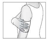 4. Przykleić plaster na bolące miejsce. Jeżeli jest to konieczne, do przymocowania plastra w pożądanym miejscu można zastosować bandaż dziany.