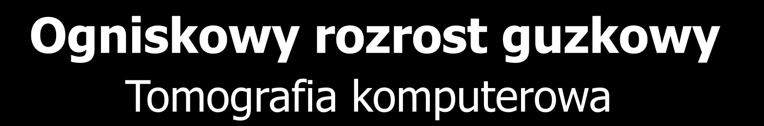 Ogniskowy rozrost guzkowy Tomografia komputerowa Typowy obraz w badaniu dynamicznym Faza