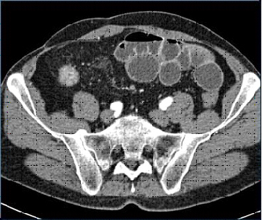 Na górze i poniżej: u tej samej 21-letniej pacjentki osiowa enterokliza CT pokazała długi segment reakcji zapalnej i poważne pogrubienie końcowego i przedkońcowego odcinka jelita