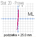 Przykładowe wykresy statokinezjogramów podczas próby kiwania (różnice w wartościach bocznego zakresu stabilności) COP LL COP COP LR Analizując wykresy statokinezjogramów