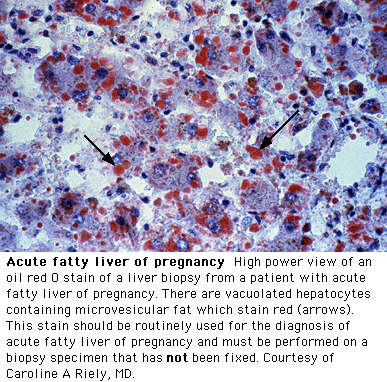 Ostre stłuszczenie wątroby ciężarnych Diagnostyczne kryteria Swansea > 6 objawów bez innego uzasadnienia Nudności & wymioty Ból brzucha (dgn.