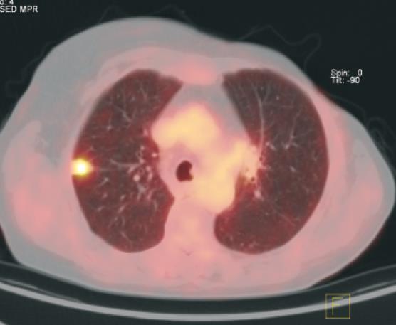 Results In 3 patients with no clinical symptoms distant metastases were found in PET scanning only due to