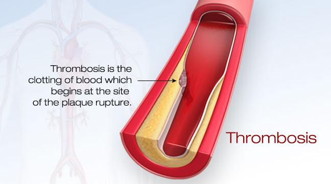 Medycyna konwencjonalna Zaawansowana zakrzepica 4 5 Jeśli tętnica jest całkowicie zablokowana przez zakrzep, to wszystkie tkanki dotychczas zasilane tlenem przez tę