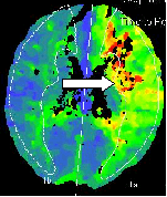 Rycina 3 a Pacjent z podejrzeniem ostrego udaru niedokrwiennego mózgu. Badanie przegl¹dowe TK g³owy bez œrodka kontrastowego. Œwie e zmiany niedokrwienne niewidoczne.