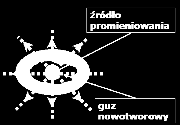 Brachyterapia (curieterapia, terapia kontaktowa) to metoda radioterapii, polegająca na napromienieniu komórek