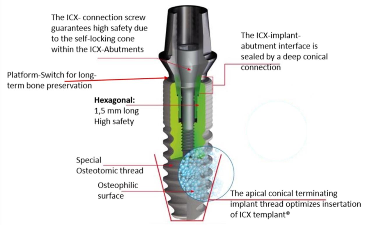 CECHY SZCZEGÓLNE SYSTEMU IMPLANTÓW ICX Ilustracja 9: Features at a glance ICX-templant Źródło: Medentis Medical, 2015 Na równoległej szyjce implantu znajduje się mikrogwint z mikroskopijnie