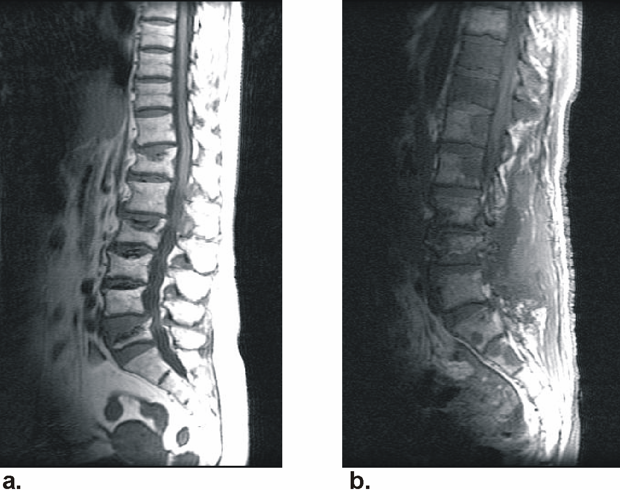 Badanie spiralnej wielorzędowej TK u chorego lat 67 z początkowym rozpoznaniem osteoporozy, u którego następnie stwierdzono szpiczaka mnogiego. a i b.