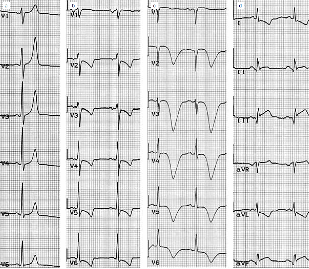 EKG w OZW Szpiczaste zał. T Obniżenie ST, ujemne zał T Głębokie, ujemne zał.