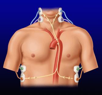 max EKG VET X PARAMETRY HEMODYNAMICZNE: SV f(dz,vet, Z0) max objętość wyrzutowa (STROKE VOLUME) dz max - amplituda fali skurczowej VET