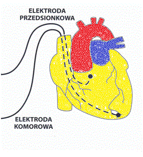 Pierwsza litera kodu oznacza D dual, czyli stymulator musi być wyposażony w dwie elektrody przedsionkową (A), oraz komorową (V), D= Dual = A + V.