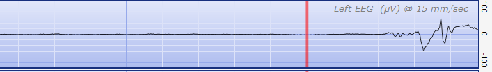 Burst Suppression cisza/wyładowanie Brak cykli sen-czuwanie SWC Górny margines >10μV