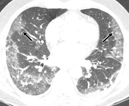 Chest Radiographic and CT Findings in Novel