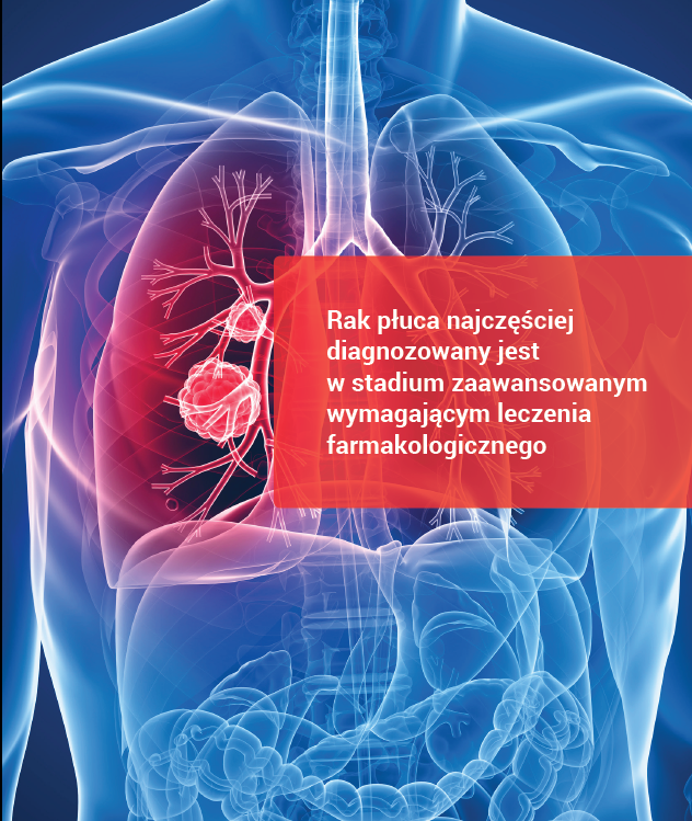 Rakpłuca jest najczęściejdiagnozowanym nowotworemzłośliwym, najczęstsząprzyczyną zgonu z powodu