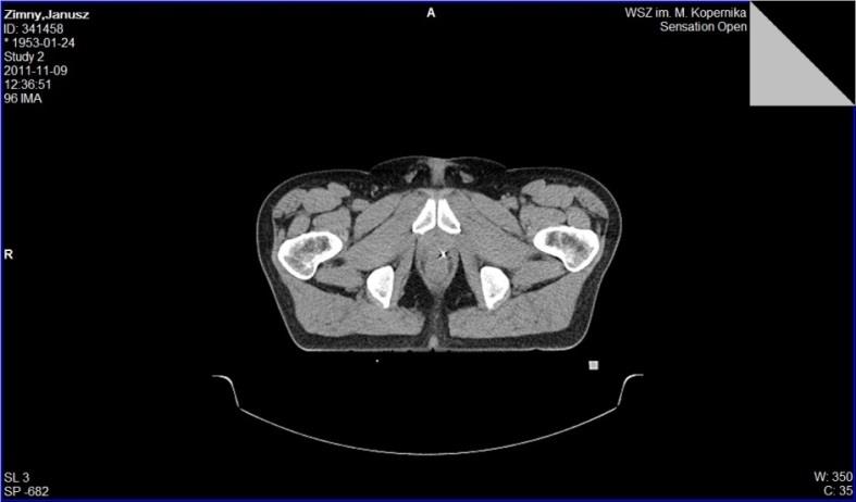 Implantacja