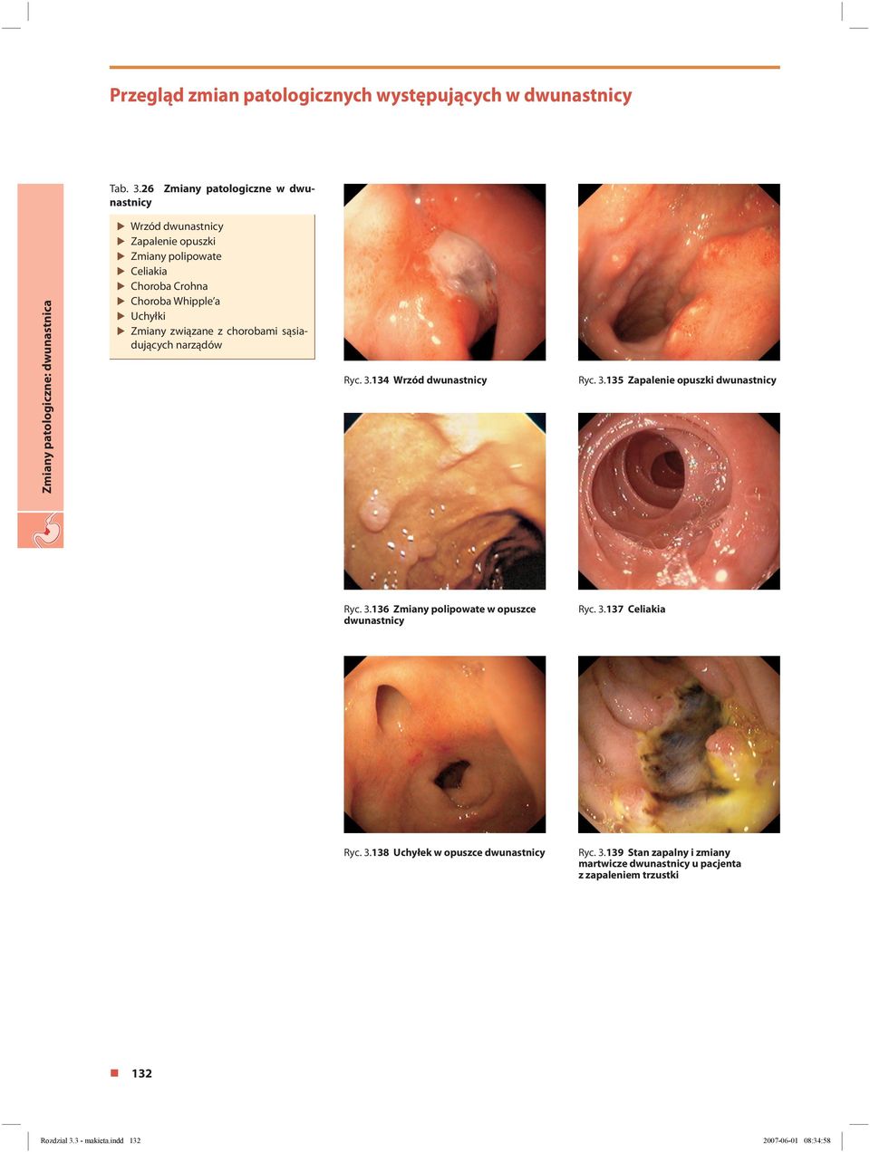 Uchyłki Zmiany związane z chorobami sąsiadujących narządów Ryc..14 Wrzód dwunastnicy Ryc..15 Zapalenie opuszki dwunastnicy Ryc.