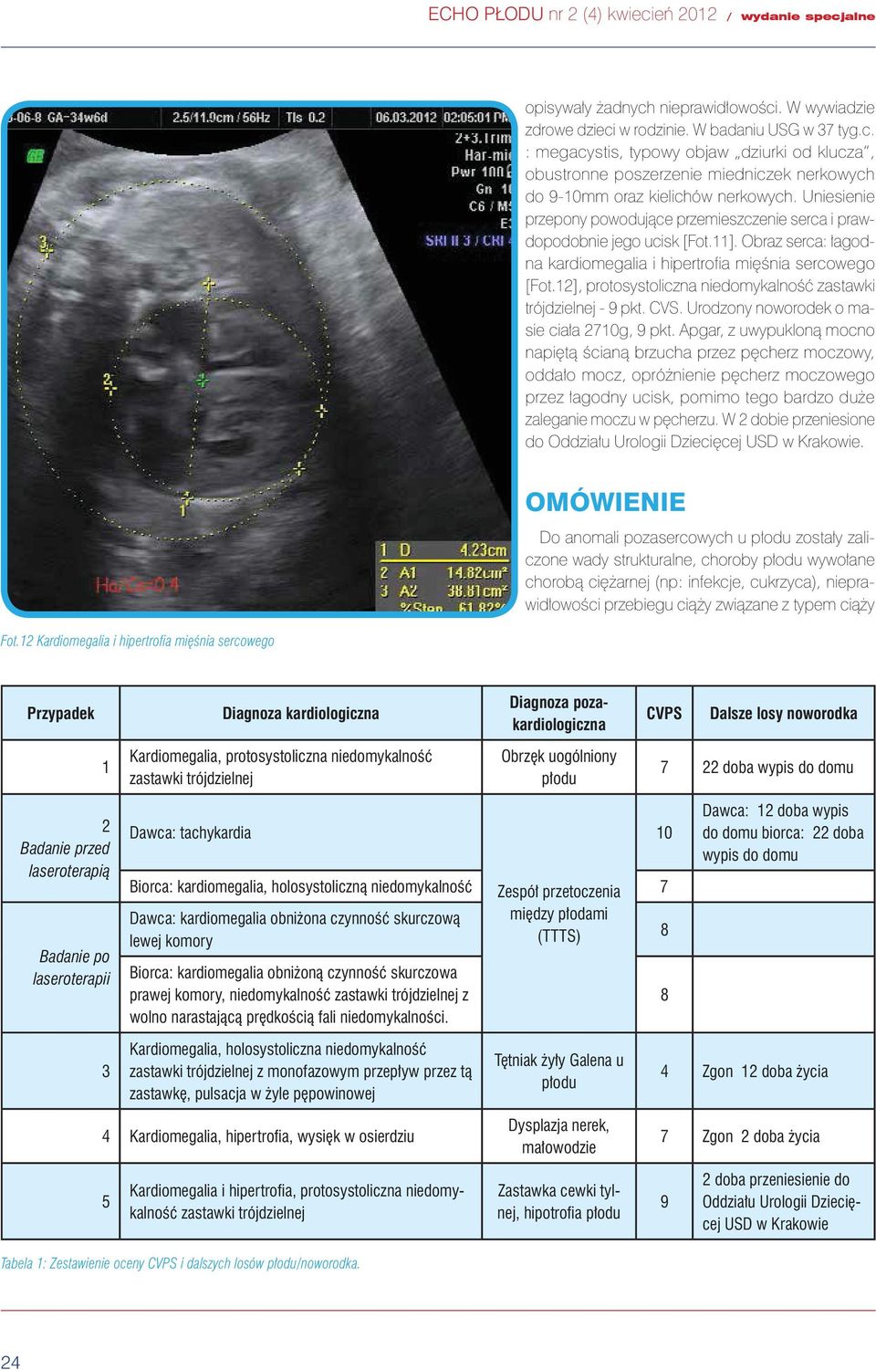12], protosystoliczna niedomykalność zastawki trójdzielnej - 9 pkt. CVS. Urodzony noworodek o masie ciała 2710g, 9 pkt.
