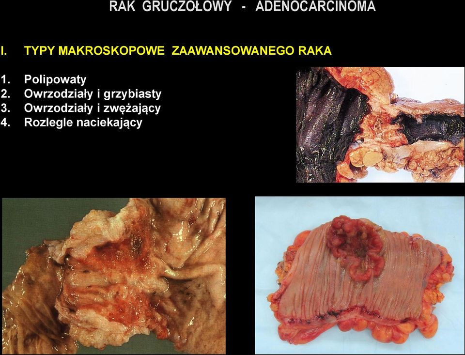 Polipowaty 2. Owrzodziały i grzybiasty 3.