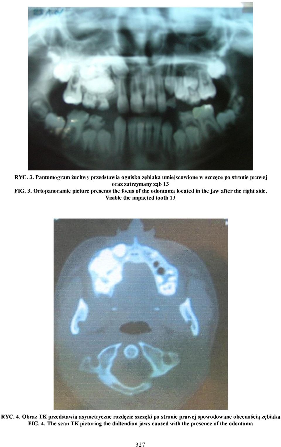 FIG. 3. Ortopanoramic picture presents the focus of the odontoma located in the jaw after the right side.