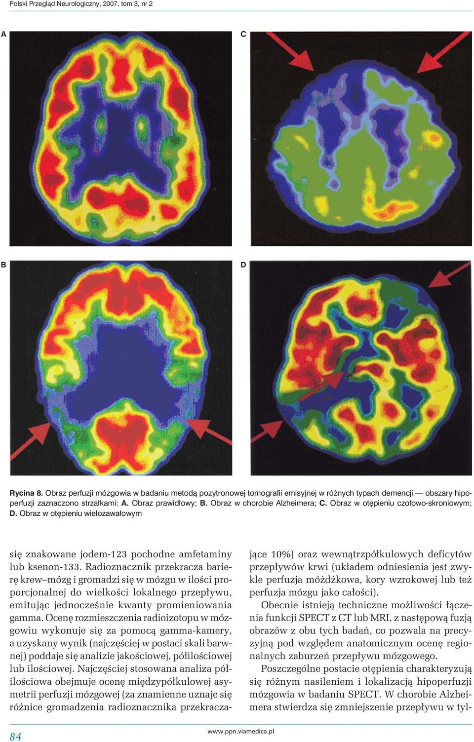 Obraz w otępieniu czołowo-skroniowym; D. Obraz w otępieniu wielozawałowym się znakowane jodem-123 pochodne amfetaminy lub ksenon-133.