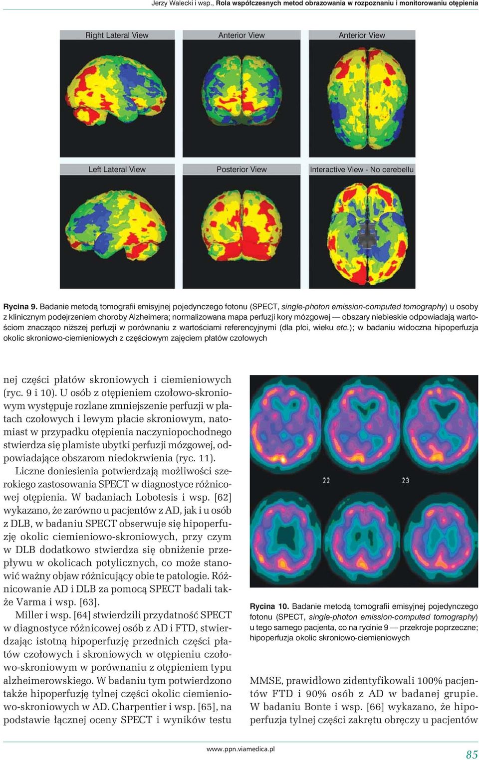 Badanie metodą tomografii emisyjnej pojedynczego fotonu (SPECT, single-photon emission-computed tomography) u osoby z klinicznym podejrzeniem choroby Alzheimera; normalizowana mapa perfuzji kory