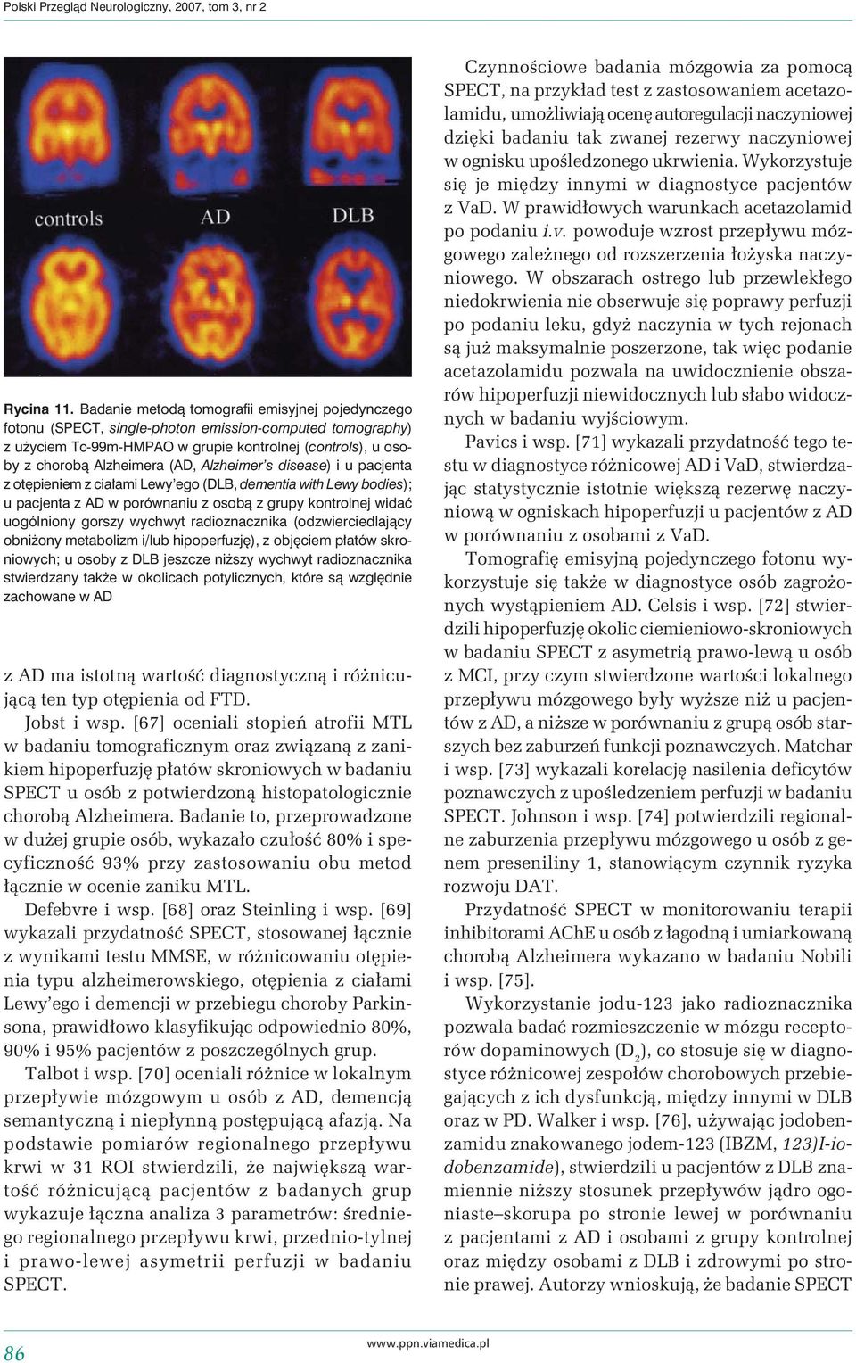 Alzheimer s disease) i u pacjenta z otępieniem z ciałami Lewy ego (DLB, dementia with Lewy bodies); u pacjenta z AD w porównaniu z osobą z grupy kontrolnej widać uogólniony gorszy wychwyt