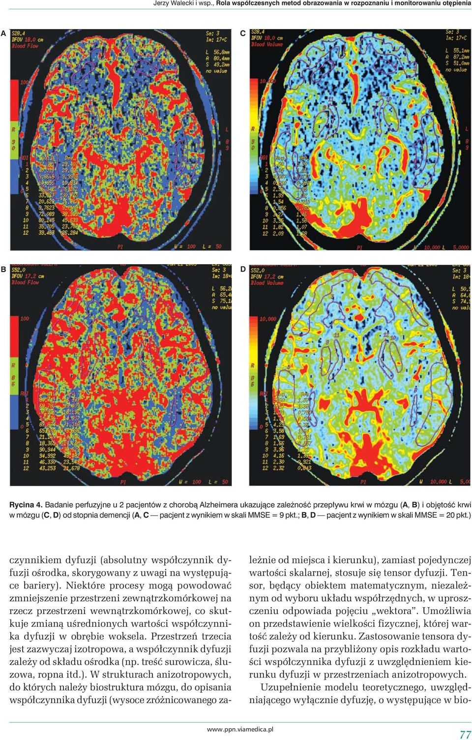 pkt.; B, D pacjent z wynikiem w skali MMSE = 20 pkt.) czynnikiem dyfuzji (absolutny współczynnik dyfuzji ośrodka, skorygowany z uwagi na występujące bariery).