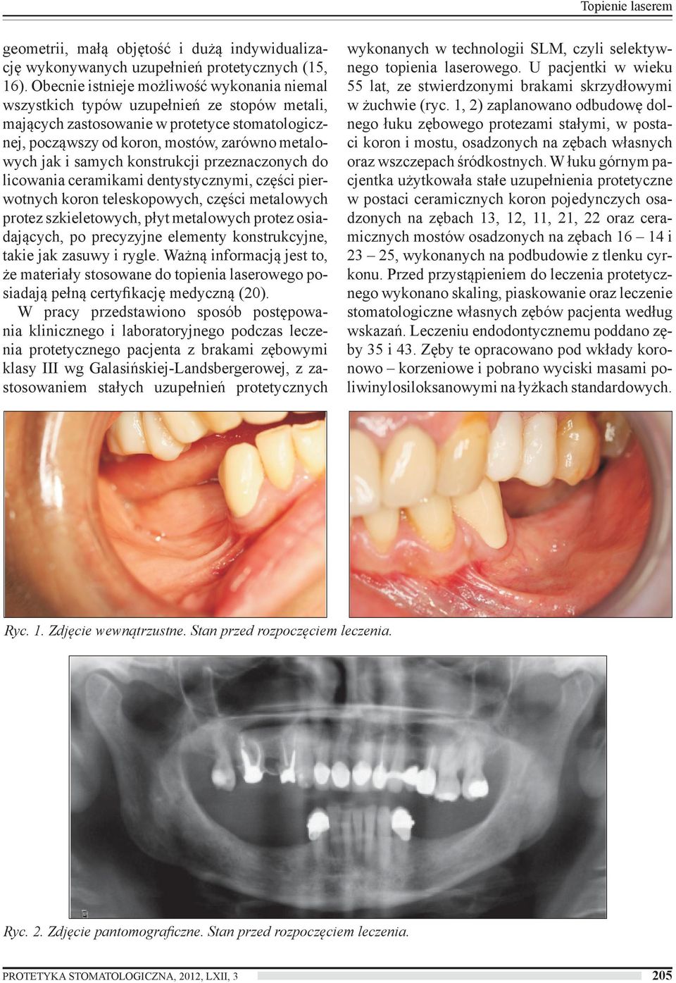 samych konstrukcji przeznaczonych do licowania ceramikami dentystycznymi, części pierwotnych koron teleskopowych, części metalowych protez szkieletowych, płyt metalowych protez osiadających, po