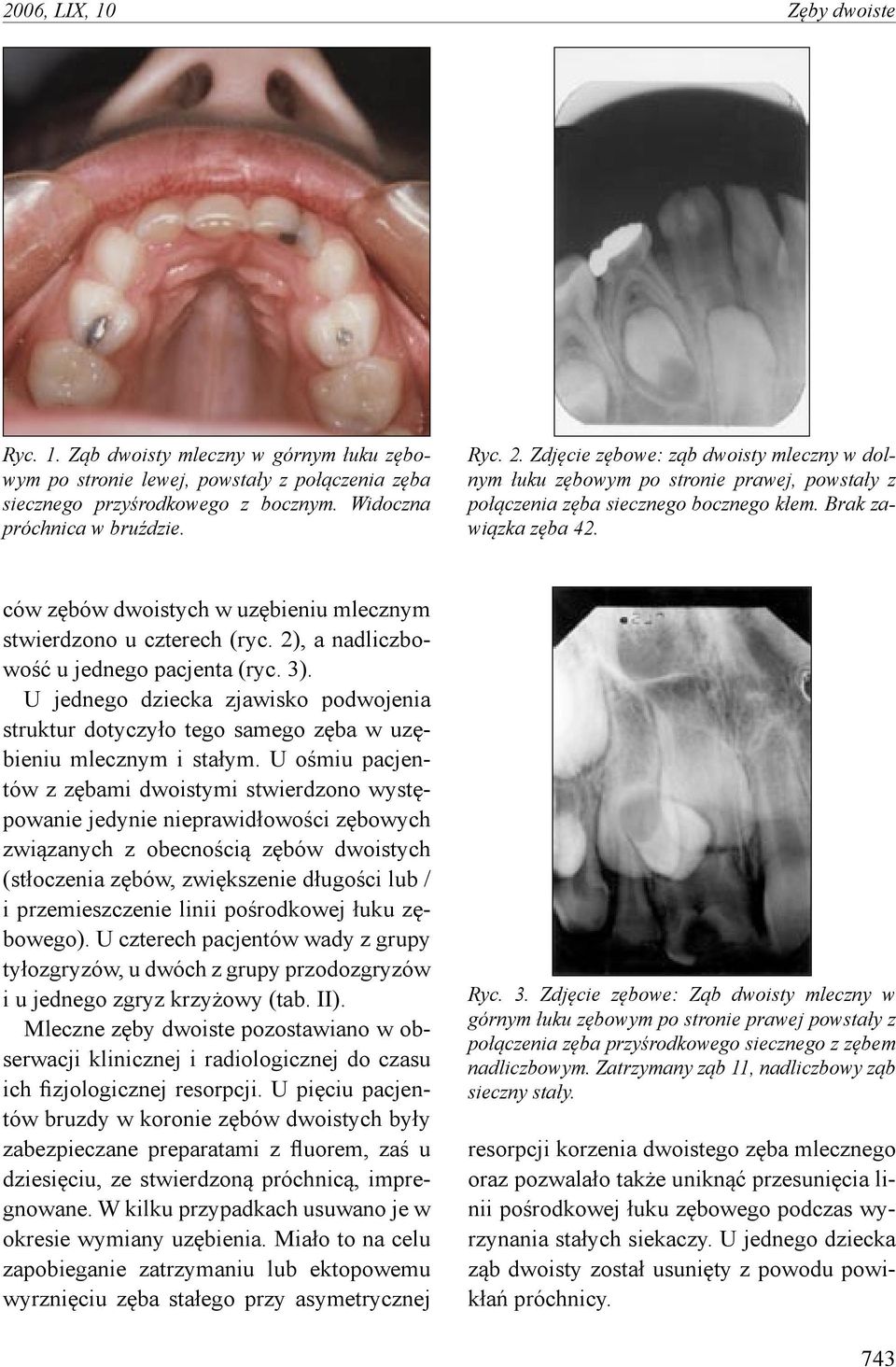 ców zębów dwoistych w uzębieniu mlecznym stwierdzono u czterech (ryc. 2), a nadliczbowość u jednego pacjenta (ryc. 3).