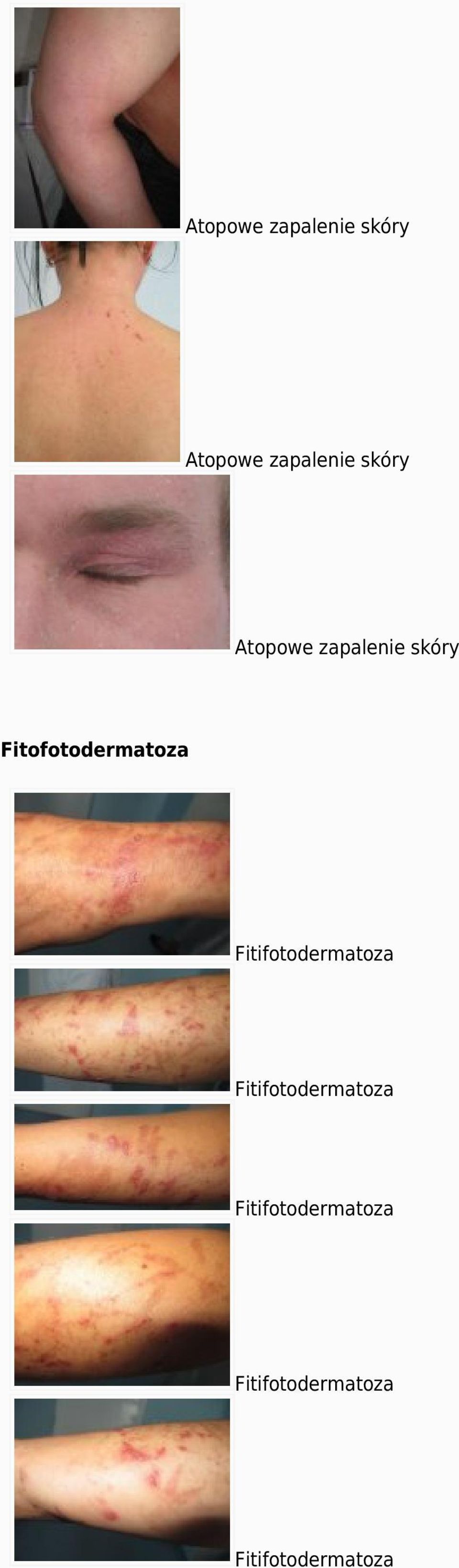 Fitofotodermatoza Fitifotodermatoza