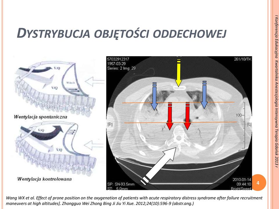 respiratory distress syndrome after failure recruitment maneuvers