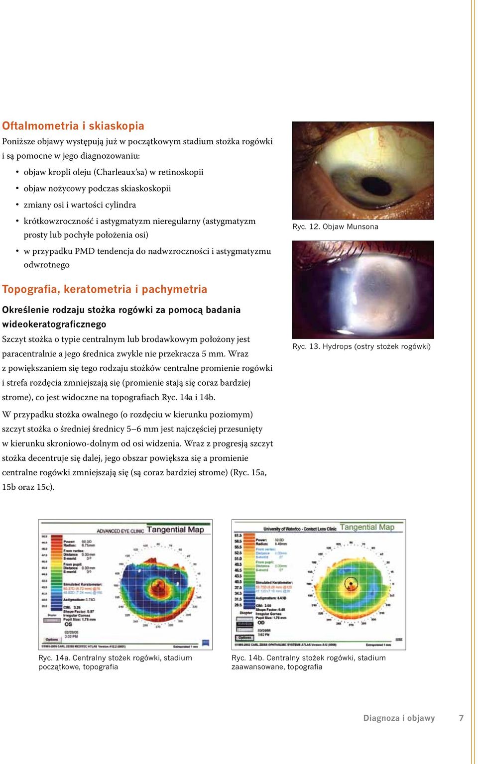 Objaw Munsona w przypadku PMD tendencja do nadwzroczności i astygmatyzmu odwrotnego Topografia, keratometria i pachymetria Określenie rodzaju stożka rogówki za pomocą badania wideokeratograficznego