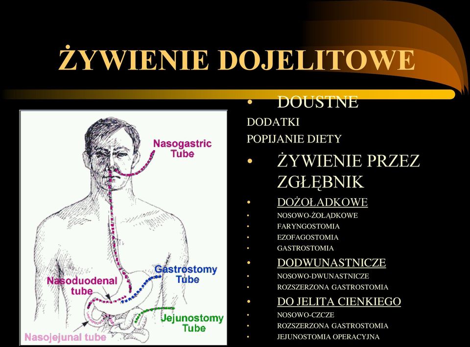 GASTROSTOMIA DODWUNASTNICZE NOSOWO-DWUNASTNICZE ROZSZERZONA