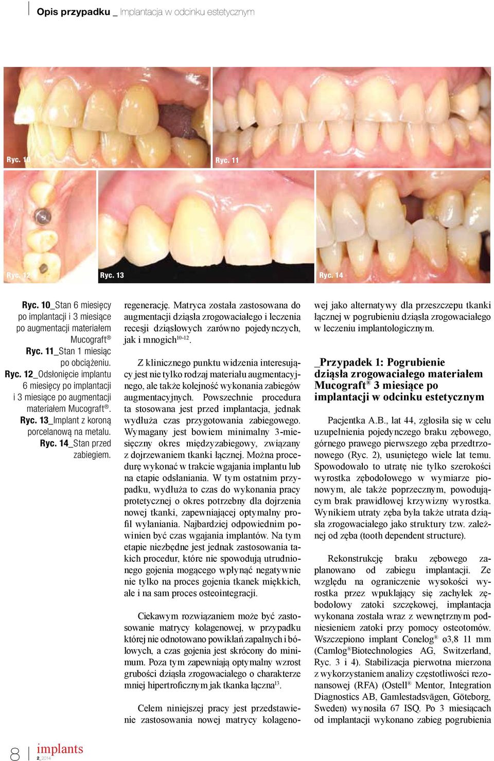 8 2_2014 regenerację. Matryca została zastosowana do augmentacji dziąsła zrogowaciałego i leczenia recesji dziąsłowych zarówno pojedynczych, jak i mnogich 10-12.