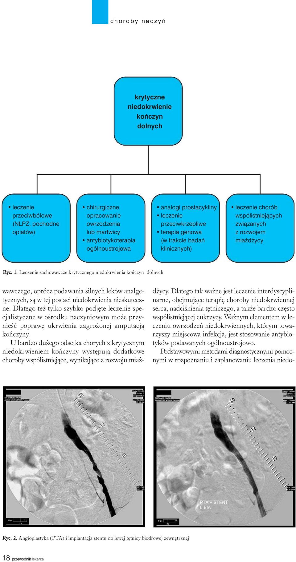 Podstawowymi metodami diagnostycznymi pomocnymi w rozpoznaniu i zaplanowaniu leczenia niedokrytyczne niedokrwienie kończyn dolnych leczenie przeciwbólowe (NLPZ, pochodne opiatów) chirurgiczne