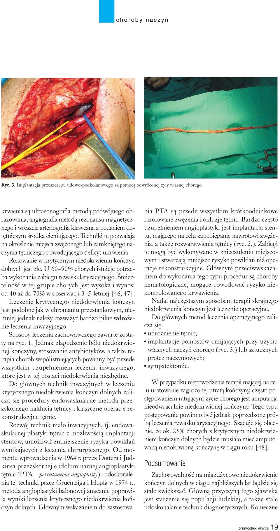 arteriografia klasyczna z podaniem dotêtniczym œrodka cieniuj¹cego. Techniki te pozwalaj¹ na okreœlenie miejsca zwê onego lub zamkniêtego naczynia têtniczego powoduj¹cego deficyt ukrwienia.