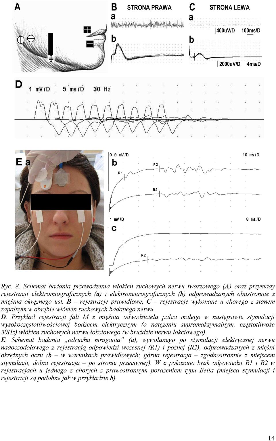ust. B rejestracje prawidłowe, C rejestracje wykonane u chorego z stanem zapalnym w obrębie włókien ruchowych badanego nerwu. D.