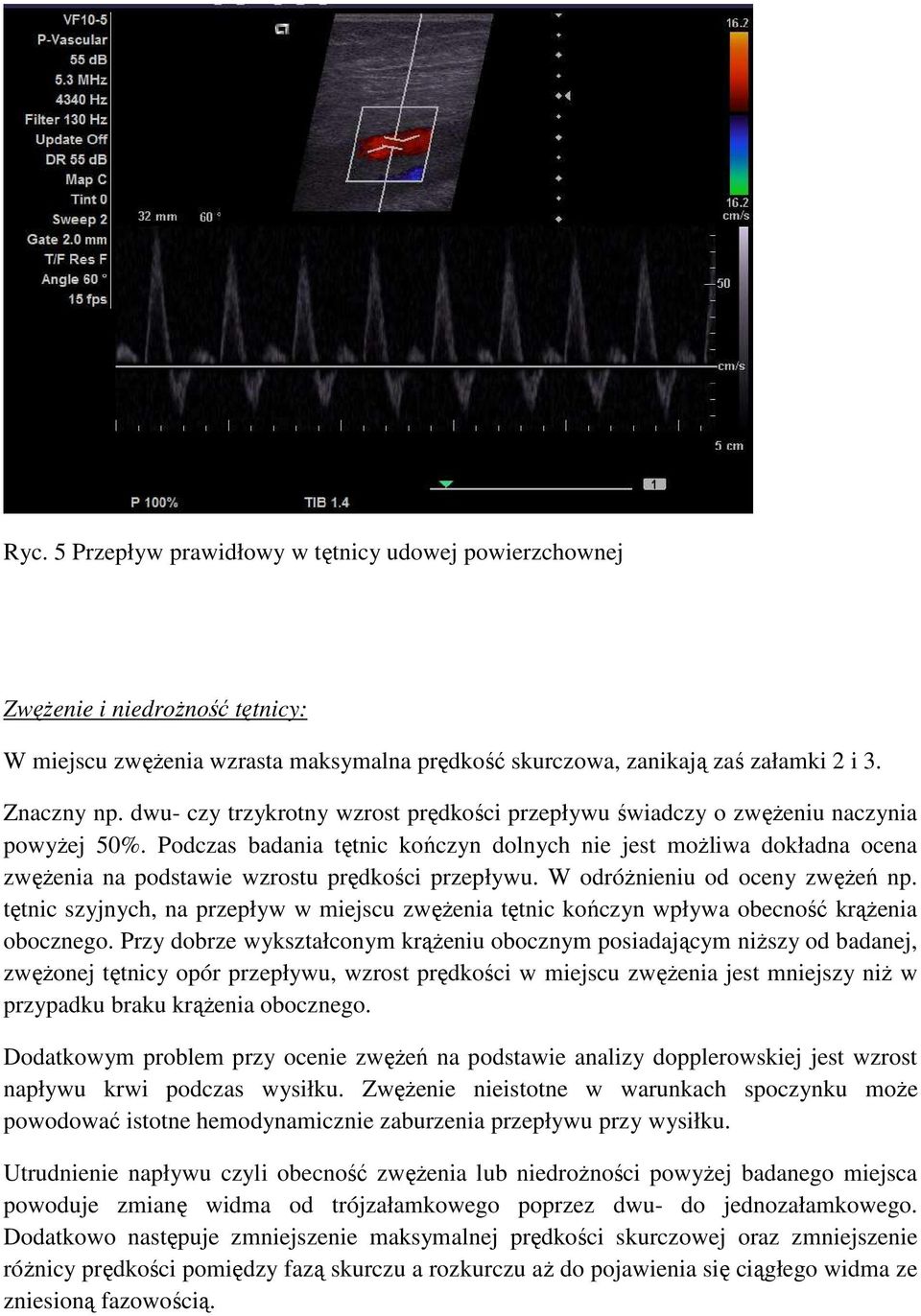 Podczas badania tętnic kończyn dolnych nie jest moŝliwa dokładna ocena zwęŝenia na podstawie wzrostu prędkości przepływu. W odróŝnieniu od oceny zwęŝeń np.