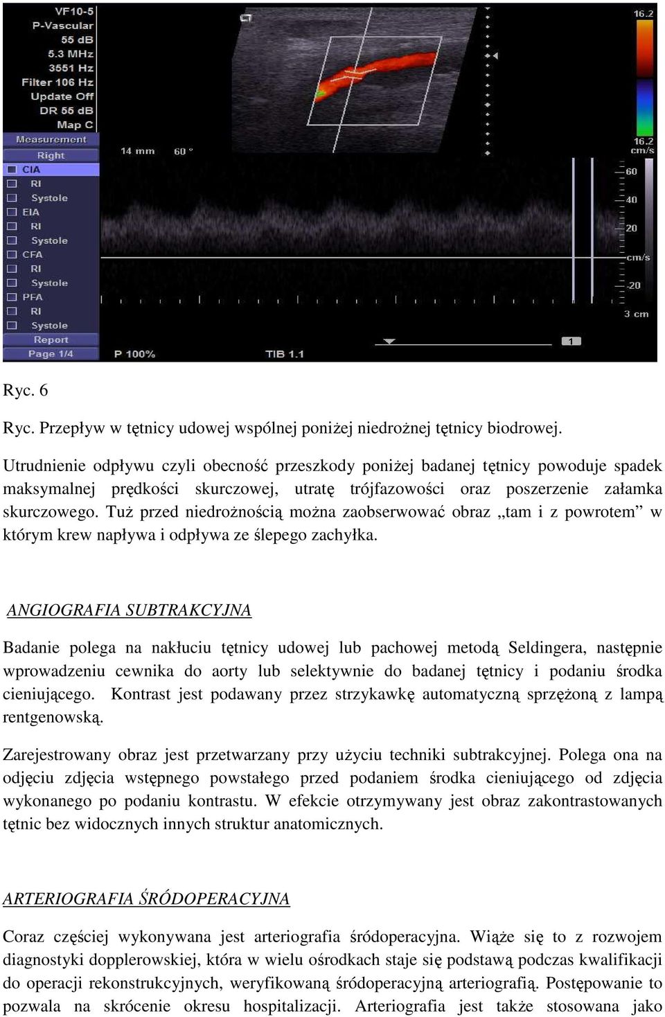 TuŜ przed niedroŝnością moŝna zaobserwować obraz tam i z powrotem w którym krew napływa i odpływa ze ślepego zachyłka.