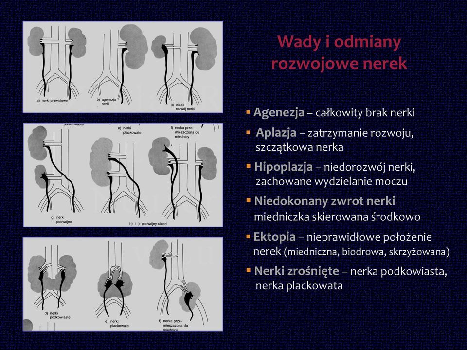 Niedokonany zwrot nerki miedniczka skierowana środkowo Ektopia nieprawidłowe położenie