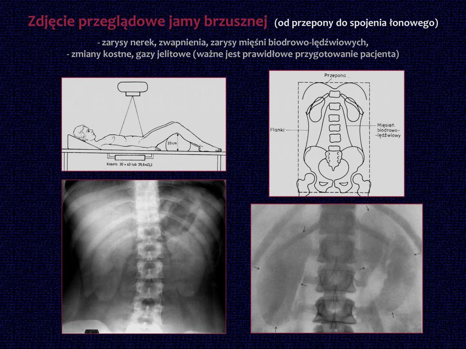 zarysy mięśni biodrowo-lędźwiowych, - zmiany kostne,