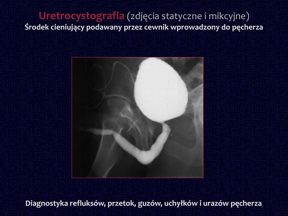 cewnik wprowadzony do pęcherza Diagnostyka