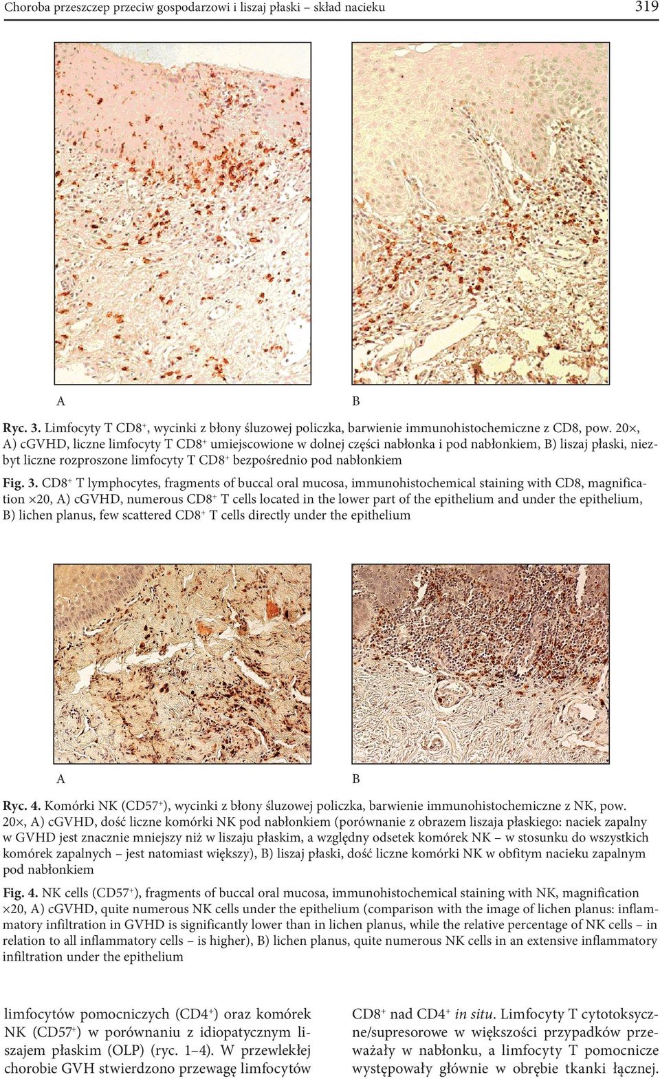 CD8+ T lymphocytes, fragments of buccal oral mucosa, immunohistochemical staining with CD8, magnification 20, A) cgvhd, numerous CD8+ T cells located in the lower part of the epithelium and under the