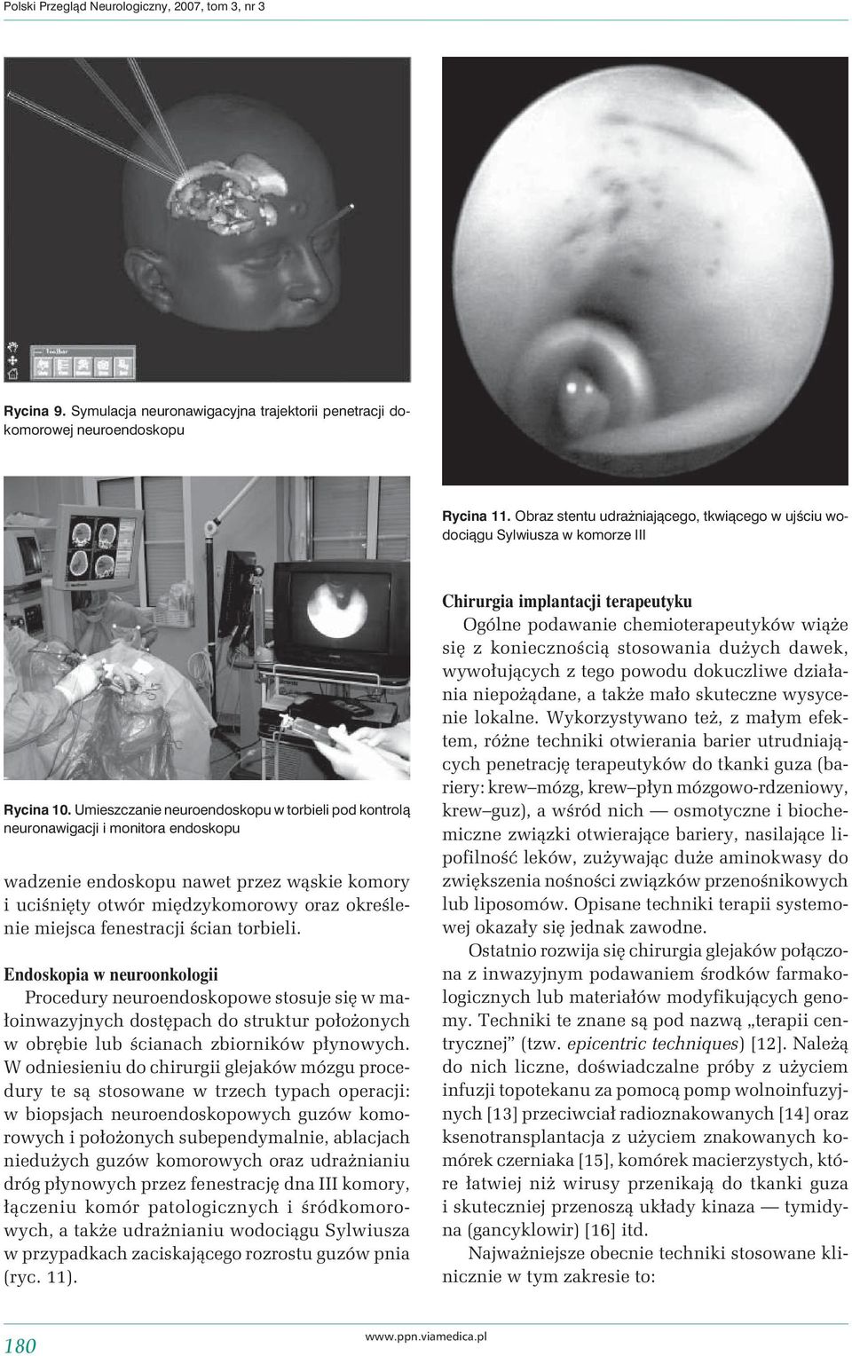 Umieszczanie neuroendoskopu w torbieli pod kontrolą neuronawigacji i monitora endoskopu wadzenie endoskopu nawet przez wąskie komory i uciśnięty otwór międzykomorowy oraz określenie miejsca