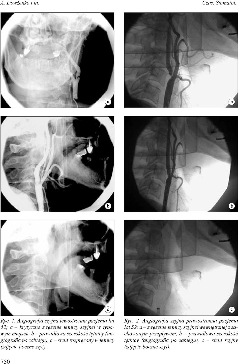 szerokość tętnicy (angiografia po zabiegu), c stent rozprężony w tętnicy (zdjęcie boczne szyi). Ryc. 2.