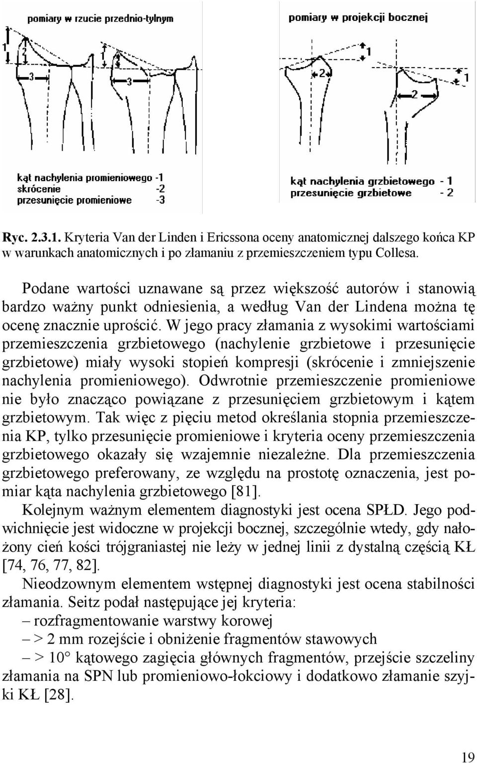 W jego pracy złamania z wysokimi wartościami przemieszczenia grzbietowego (nachylenie grzbietowe i przesunięcie grzbietowe) miały wysoki stopień kompresji (skrócenie i zmniejszenie nachylenia