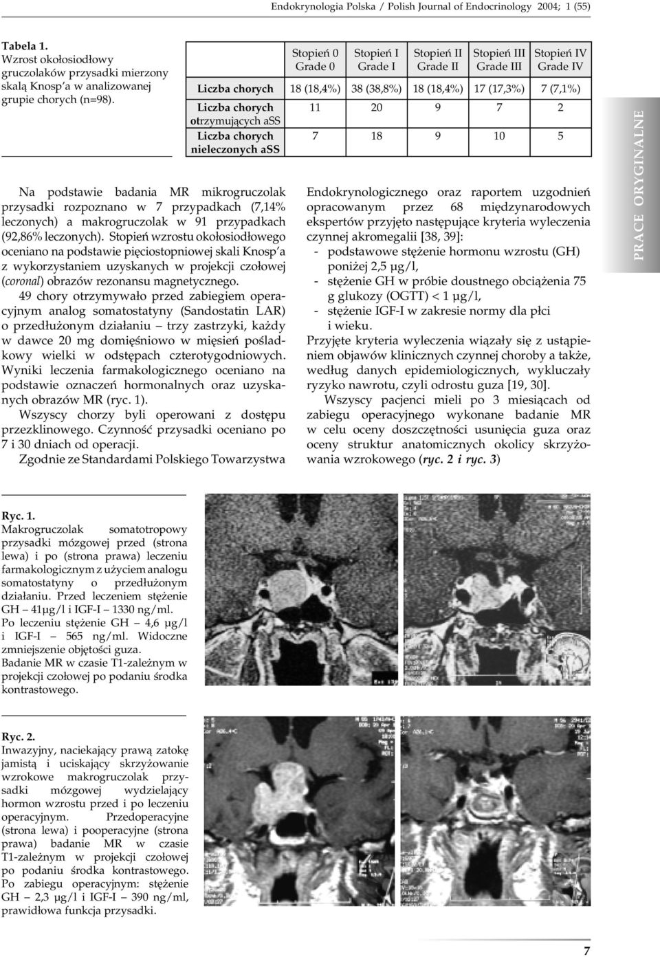 Stopień wzrostu okołosiodłowego oceniano na podstawie pięciostopniowej skali Knosp a z wykorzystaniem uzyskanych w projekcji czołowej (coronal) obrazów rezonansu magnetycznego.