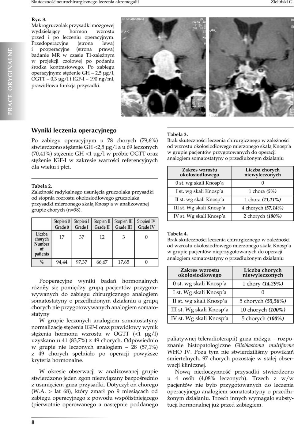 Po zabiegu operacyjnym: stężenie GH 2,5 µg/l, OGTT 0,3 µg/l i IGF-I 190 ng/ml, prawidłowa funkcja przysadki.