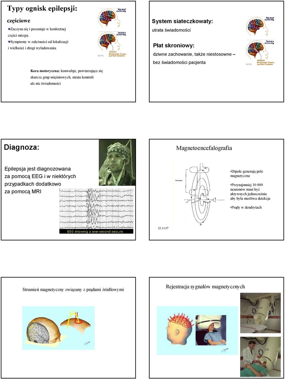 mięśniowych, utrata kontroli ale nie świadomości Diagnoza: Magnetoencefalografia Epilepsja jest diagnozowana za pomocą EEG i w niektórych przypadkach dodatkowo za pomocą MRI Dipole